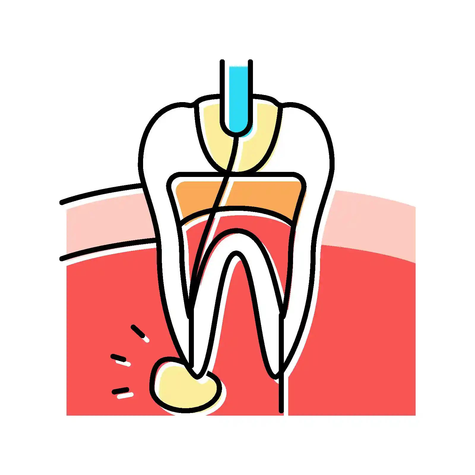 Root Canal Treatment