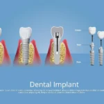 Dental Implants Process