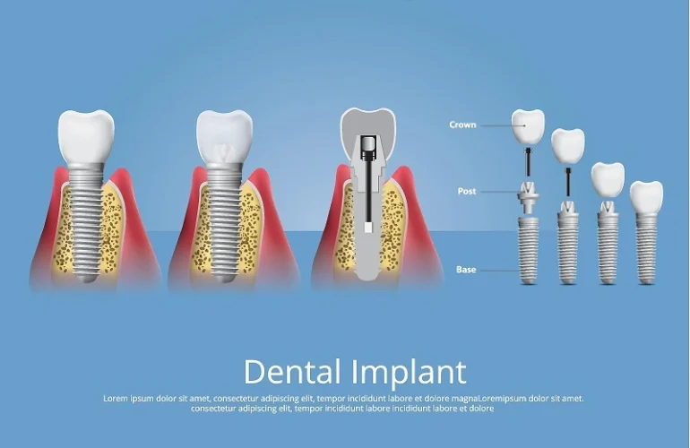 Dental Implants Process