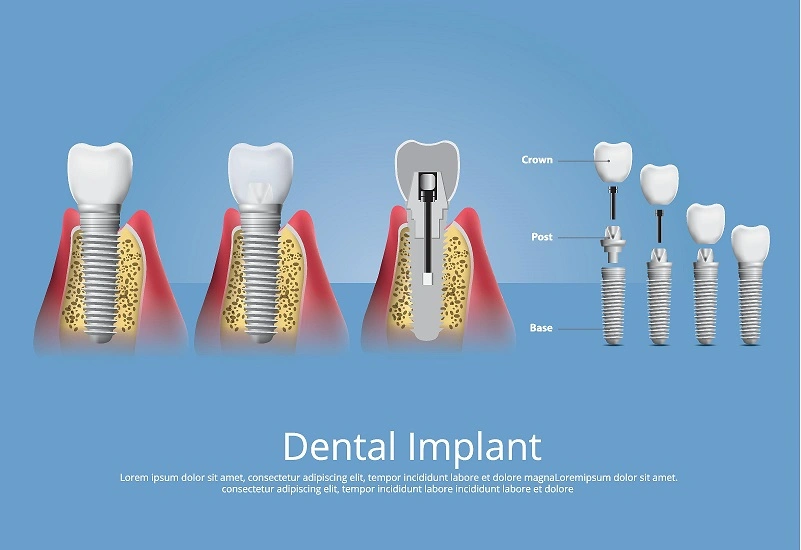 Dental Implants Process