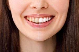 Teeth whitening before after | Dentist in Connah's qauy